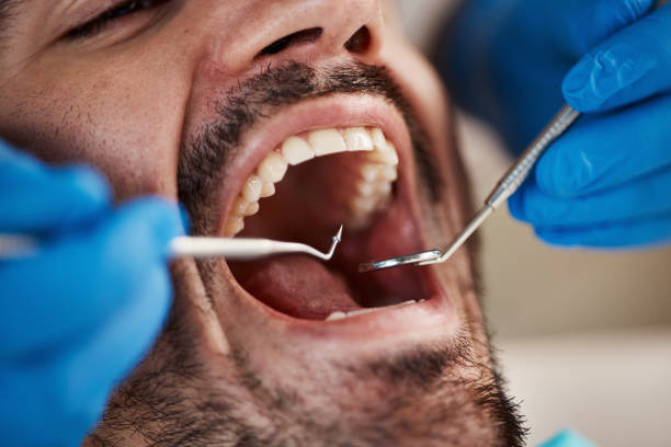 Best Emergency Wisdom Teeth Removal in Rosedale, WA